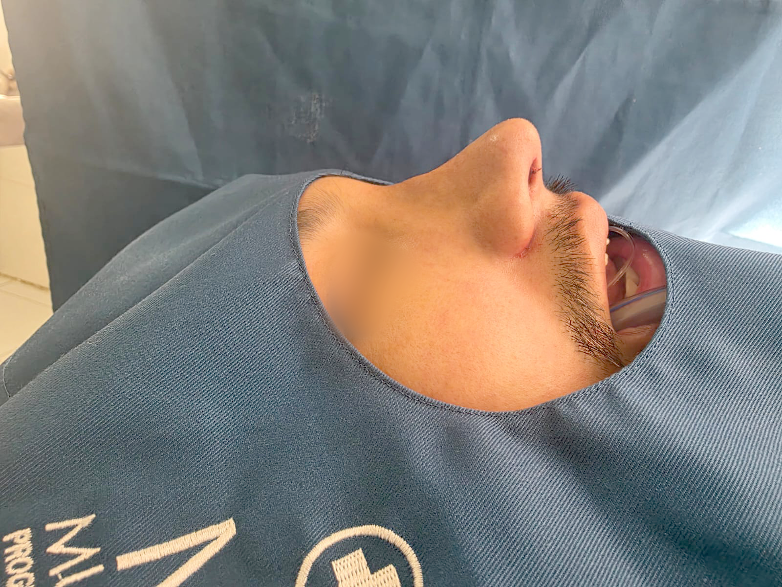 Después de Rinoplastia — Multiestetika Médica